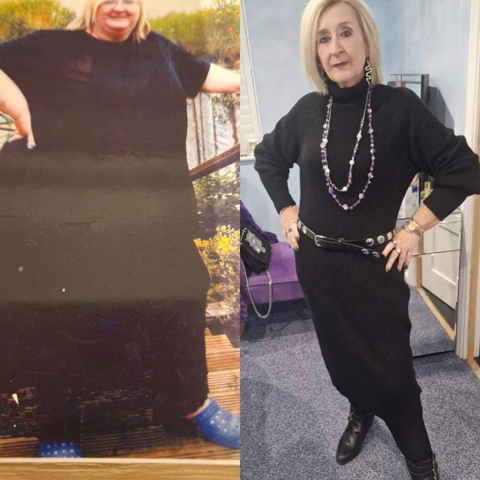 Amanda before and after body contouring surgery