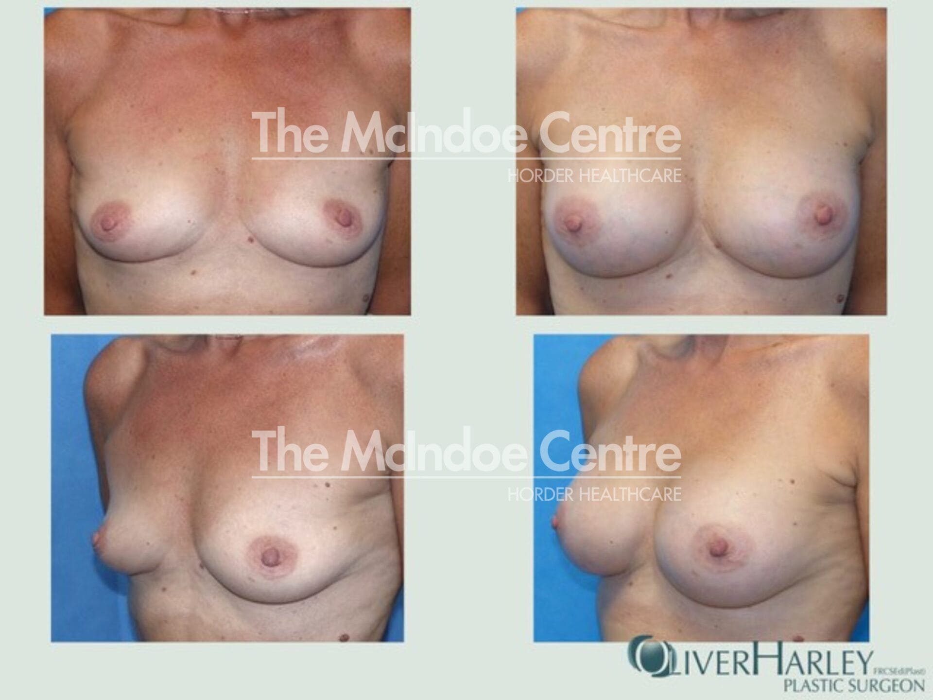 Before & After_ mandy king