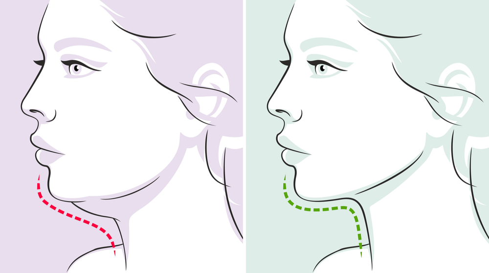 Chin Liposuction BF