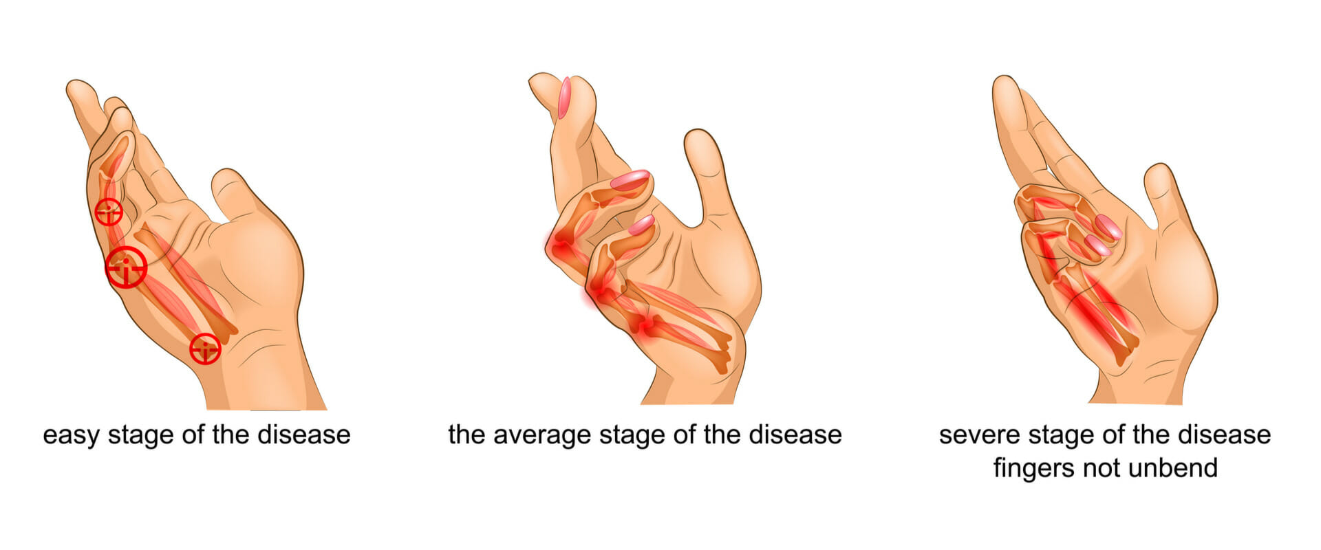 Dupuytrens contracture Dupuytren's contracture