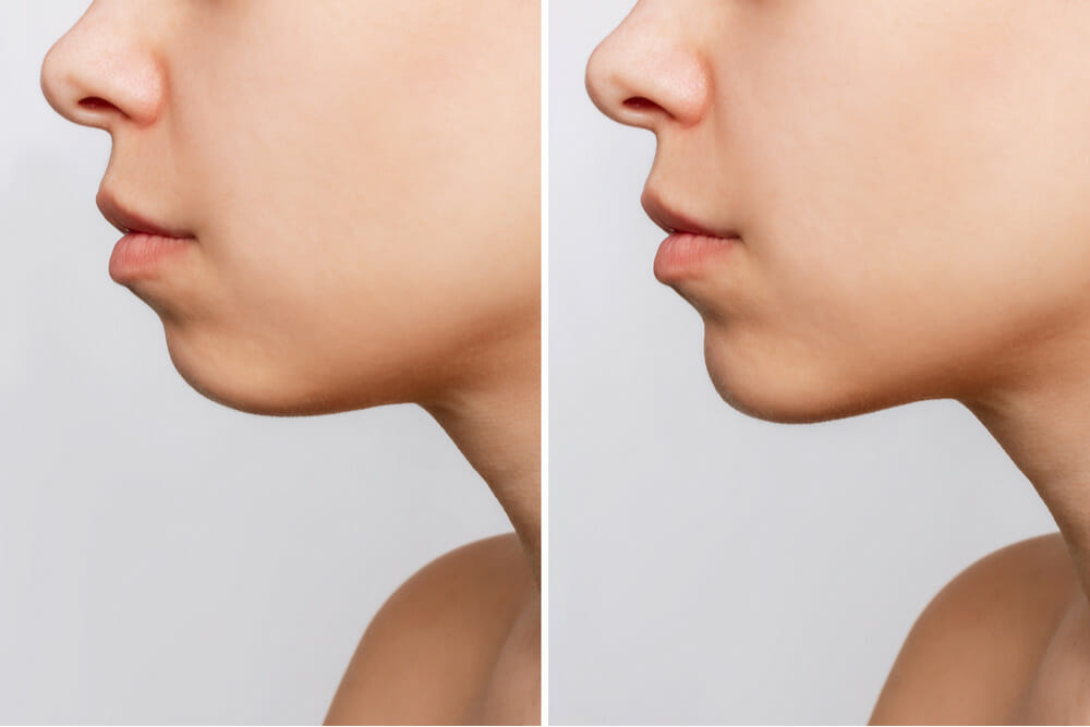 Genioplasty Genioplasty