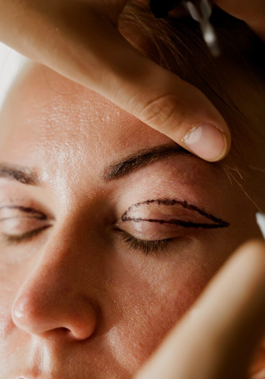 Blepharoplasty - eyelid surgery