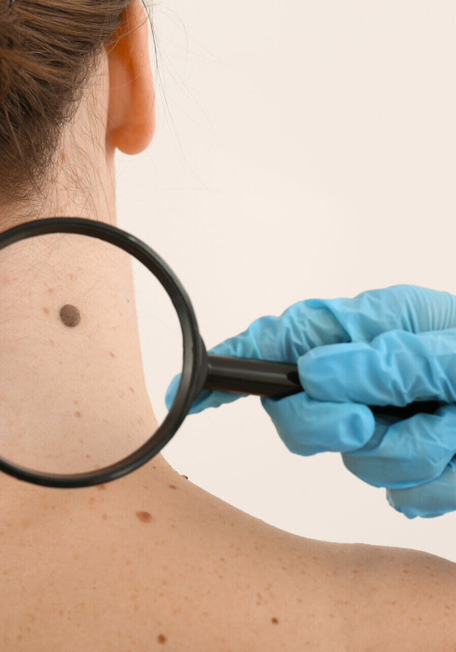 Dermatologist,Examining,Moles,Of,Patient,On,Light,Background